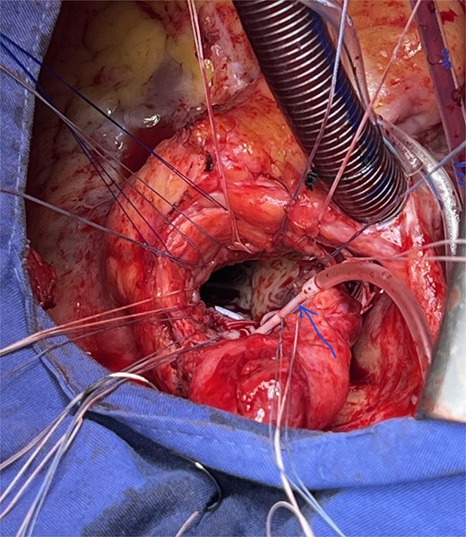 Insert a coronary cannula (arrow) into the left common coronary artery.