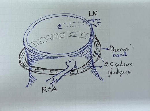 Schematic illustration of enhanced Dacron band location.