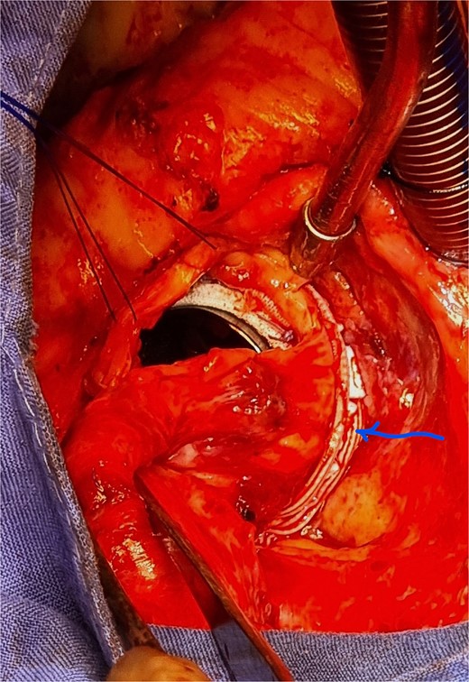 Dacron band outside after tying the suture (arrow).