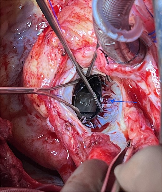‘Spoke’ pattern dehiscence (arrow).