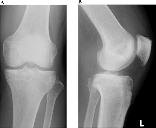 Preoperative plain radiographic images of the left knee. Articular depression of the tibia is shown on a lateral-view radiograph.
