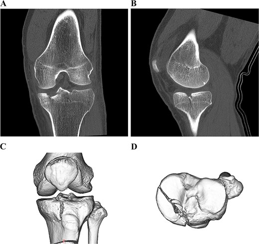 Preoperative CT scan images of the left knee. Coronal and sagittal CT scan images (A, B). 3D CT scan images (C, D).