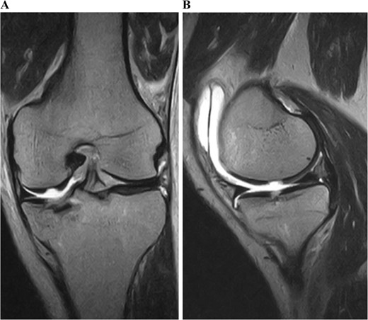 Preoperative T2-weighted magnetic resonance images of the left knee. A cartilage injury of the medial femoral condyle appeared as a kissing lesion opposite the tibial plateau fracture. The coronal image revealed a 20-mm-wide cartilage injury (A). The sagittal image showed an 18-mm-long cartilage injury (B).