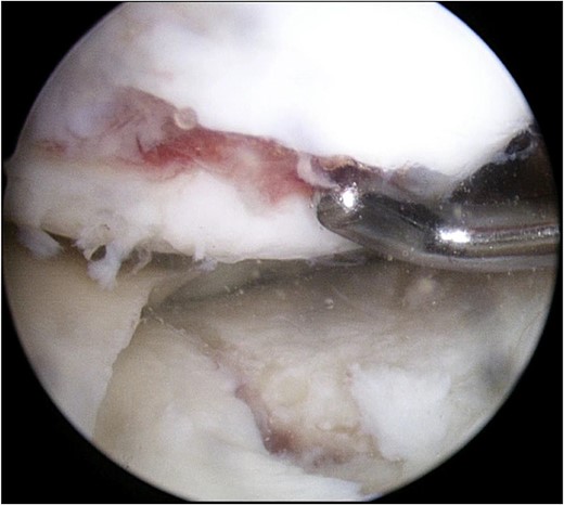 Arthroscopic findings of the medial compartment of the left knee at the initial surgery. Complete cartilage loss of the femoral condyle to the subchondral area and a depressed medial tibial plateau were observed.