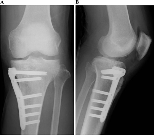 Postoperative plain radiographs of the left knee. Internal fixation was performed with the TriS Medial HTO Plate System.