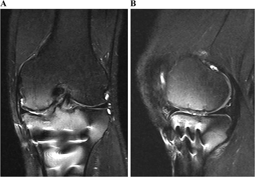 Postoperative T2-weighted fat-suppressed magnetic resonance images at 1 year after surgery. The transplanted cultured cartilage was successfully integrated without any delamination.