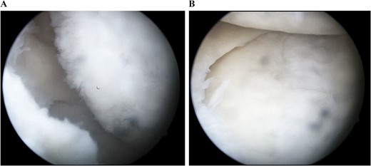 Arthroscopic findings of the medial compartment of the left knee 1 year after the surgery. The cartilage defect of the medial femoral condyle was covered by hyaline cartilage-like tissue (A). The depressed articular surface of the medial tibia plateau was smooth without step-off (B).