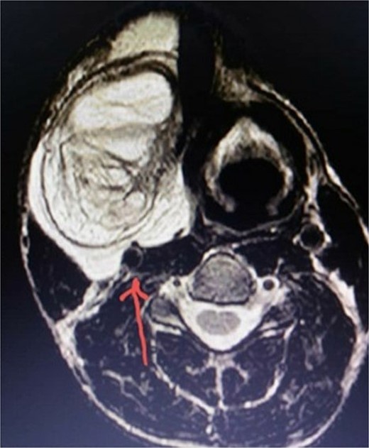 T2-weighted MRI image showing the relationship between the mass and the carotid sheath (indicated by the arrow).