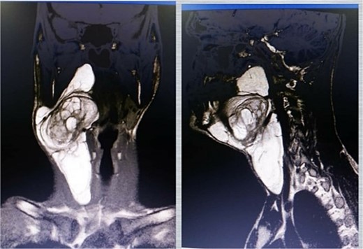 MRI images showing a high-signal mass on both T1 (left) and T2 (right) sequences.