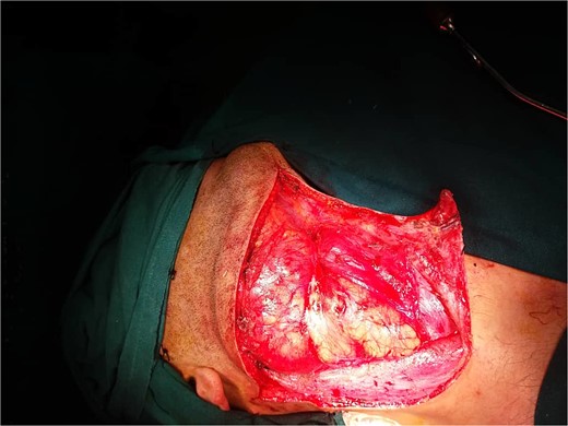 Operative image showing the mass after flap elevation.