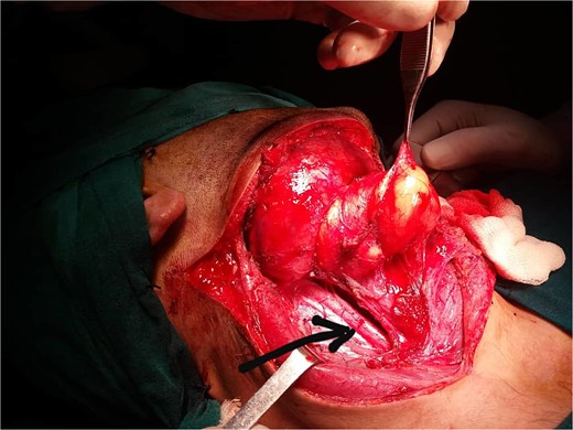 Operative image showing the relationship of the mass to the carotid artery (black arrow).