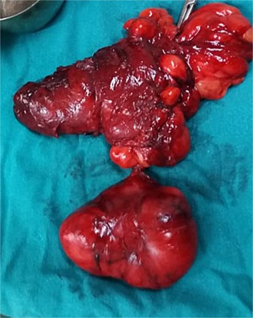 Gross image of the excised lesion, appearing as a reddish, lobulated mass.