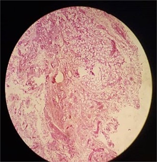 Another microscopic view of the lesion.