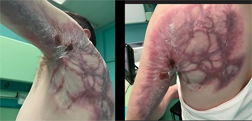 Preoperative maximal range of motion (elevation up to 70°).