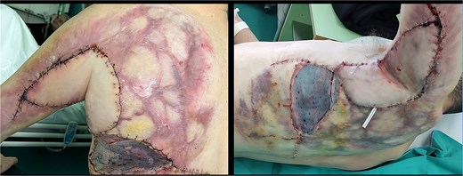 First postoperative day.