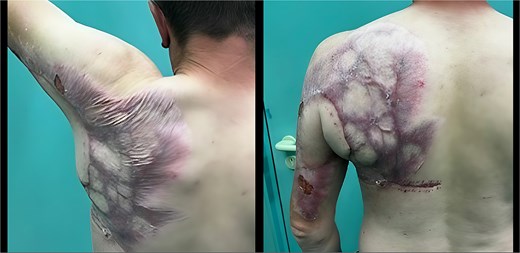 Range of motion 1 month after surgery (elevation up to 120°).