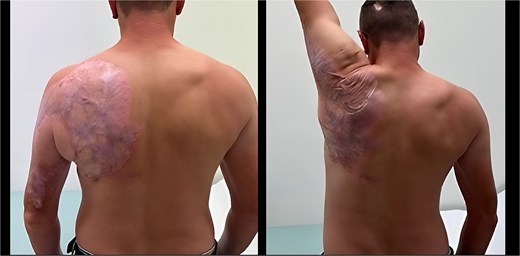 Range of motion 1 year after surgery (elevation up to 170°).