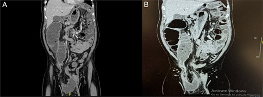 (A, B) Coronal abdominal CT showing right side inguino-scrotal hernia that contains mesenteric fat and vessels with long segment of transverse colonic loop, there is proximal dilatation of the right side of the colon reaching a competent ileo-cecal valve and not associated with dilatation of the small bowel loops. The left side colon is collapsed.