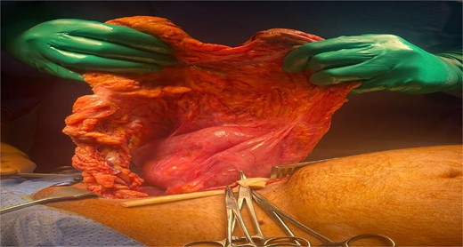 Contents of inguinal hernial sac containing TC and omentum.