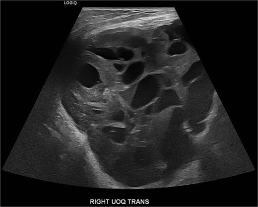 An ultrasound at that time revealed a large complex mass measuring 19 × 17 × 23 cm, with multiple solid and cystic components and no increased vascularity, consistent with BI-RADS 4.