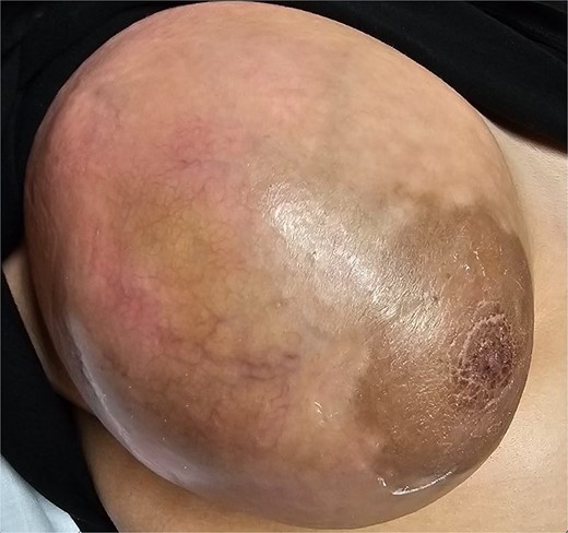 Preoperative image of breast with increased vascularity, erythema, and skin ulceration.