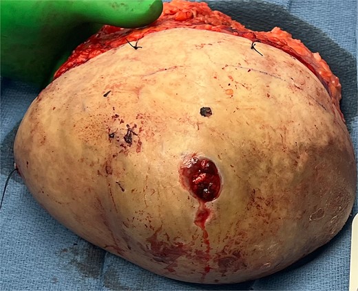 Specimen status post right mastectomy area of ulceration lateral to the nipple areolar complex, confirmed to be 24 × 12 × 7 cm with cystic component on final pathology evaluation.
