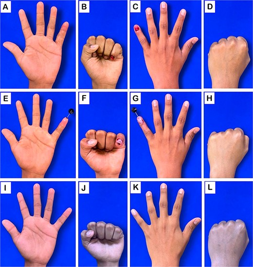 Clinical evaluation of the hand. (A–D) Preoperative images: volar and dorsal views. (E–H) Postoperative images following surgical intervention: volar and dorsal views. (I–L) images at 10-month follow-up: volar and dorsal views.