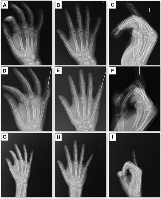 Radiographic evaluation of the hand in three planes. (A–C) Preoperative X-rays: oblique, anteroposterior, and lateral views. (D–F) Postoperative X-rays following surgical intervention: oblique, anteroposterior, and lateral views. (G–I) X-rays at 10-month follow-up: oblique, anteroposterior, and lateral views.