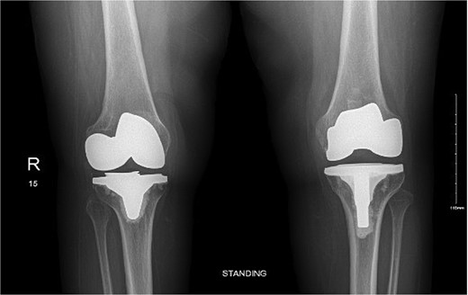 Anteroposterior view of both knees post bilateral staged total knee arthroplasty.