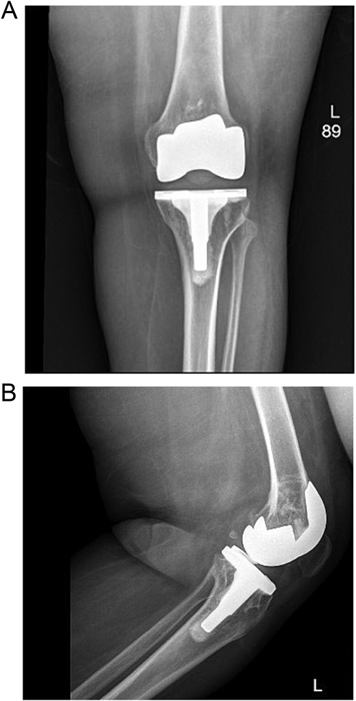 (A) Anteroposterior view of the left knee in the emergency department. (B) Lateral view of the left knee in the emergency department.