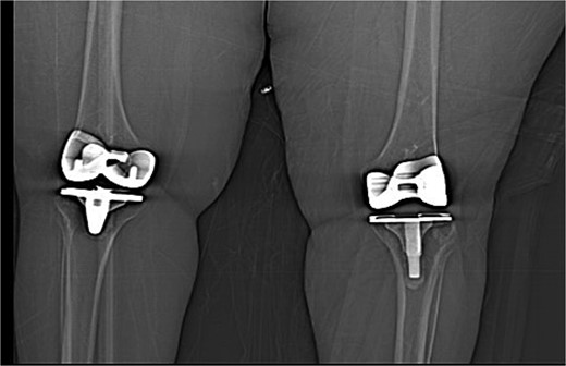 Computed tomography (CT scan) of bilateral knees showing no abnormality.
