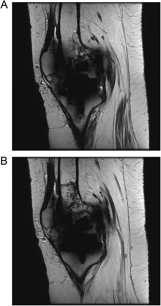 (A and B) Sagittal cuts from the MRI.