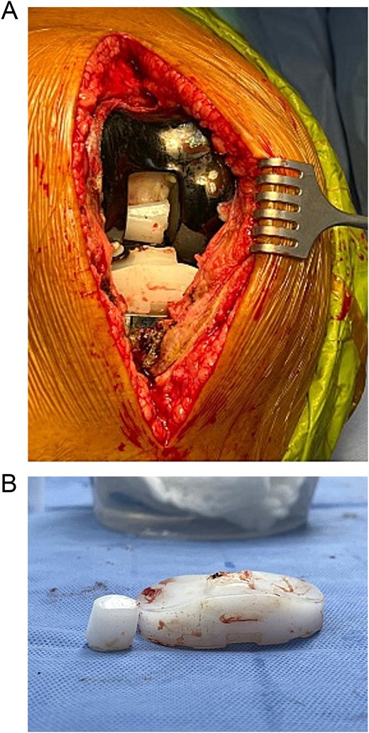 (A) Intraoperative findings showing polyethylene fracture. (B) Fractured polyethylene piece.