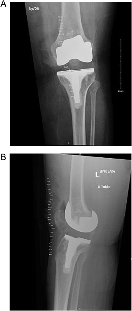 (A) Anteroposterior view of the left knee post revision and polyethylene replacement. (B) Lateral view of the left knee post revision and polyethylene replacement.