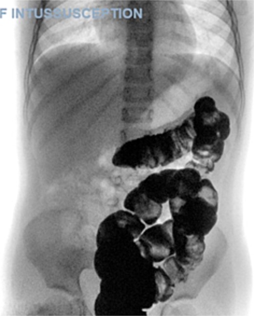 Therapeutic enema for intussusception reduction (3rd attack).
