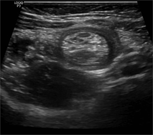 Ultrasound of the abdomen showed a target sign of intussusception (5th attack).