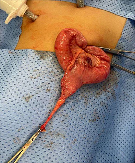 Meckel’s diverticulum as a lead point for recurrent intussusception.