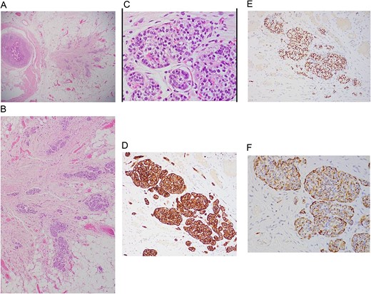 A: Low power magnification of H&E stain; tumor nest in the wall of the bowel, ribbons and cords of monomorphic cells with salt-pepper chromatin pattern, typically seen in endocrine tumors. B: Neuroendocrine tumor in the wall of bowel and fat (×20 magnification). C: Solid nest of tumor (high power magnification ×40). D: Immunohistochemistry Synaptophysin positive; Synaptophysin stains vesicles in neuroendocrine cells. E: Immunohistochemistry INSMI positive, a specific marker for neuroendocrine. F: Immunohistochemistry AE1/AE3 positive, a neuroendocrine marker.