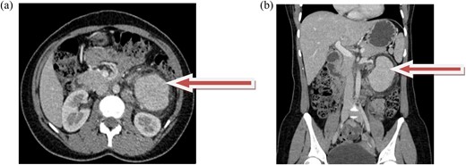 (a and b) axial and coronal computed tomographic scans, respectively, show intensely enhancing round to oval soft tissue density mass in the left retroperitoneal area anterior to the left kidney.