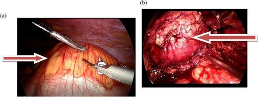 (a and b) The images show the laparoscopic view of a left retroperitoneal mass.