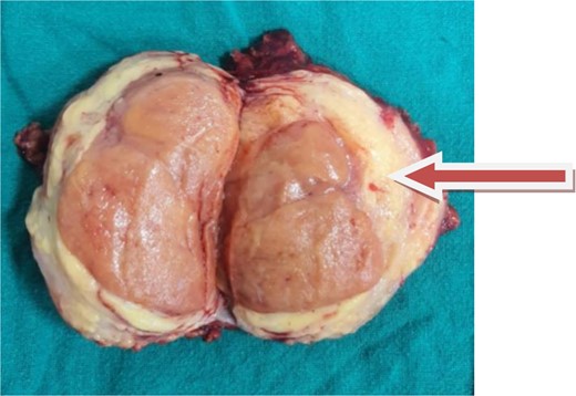 The image shows an excised tumor with a thickened capsule.