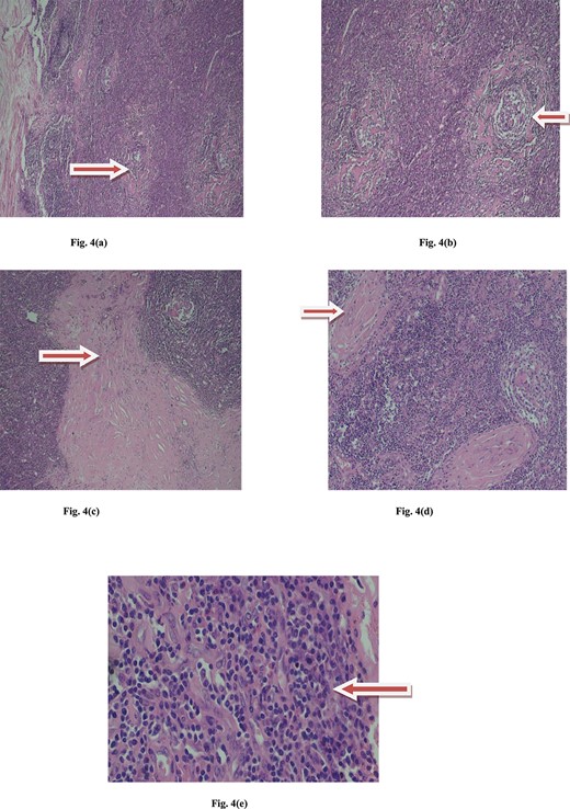 Microscopic view of Castleman disease. (a) Multiple lyphoid follicule with maintained architecture. (b) Interfollicular hypervascularity with sclerotic blood vessels. (c) Interfollicular collagenous band. (d) Sclerotic vessels with onion skin pattern. (e) Lymmmphocytes, eosinophils, plasma cells and histiocytes.