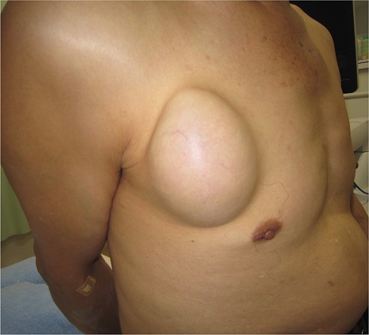 Photograph showing the lump of right pectoral region which was 90 mm in diameter, well-defined and dome-shaped.