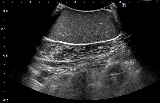 Ultrasound imaging showing hypoechoic and well-circumscribed oval mass containing variable echogenic foci and filiform anechoic areas.
