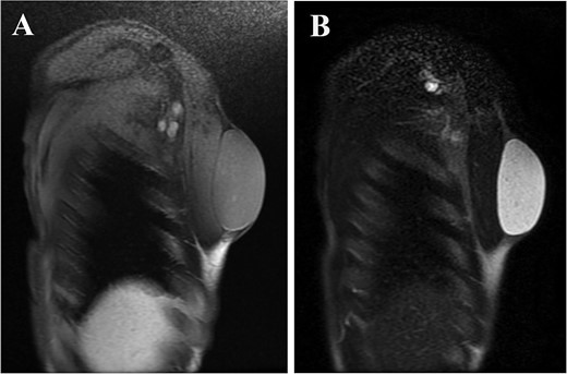 Sagittal magnetic resonance image showed well-defined, oval-shaped lesion with isointense signal relative to the muscle on T1-weighted image (Fig. 3A), and hyperintense signal on T2-weighted image (Fig. 3B).