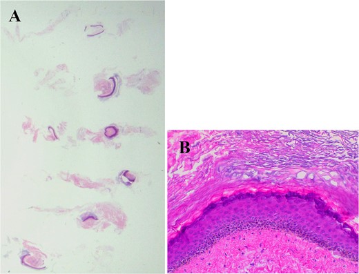Six core needle specimens containing cystic walls were sampled by core needle biopsy, hematoxylin, and eosin stain, ×2 magnification (Fig. 4A). Cystic wall was lined by mature stratified squamous epithelium with granular layer and did not contain adnexal structure, hematoxylin, and eosin stain, ×20 magnification (Fig. 4B).