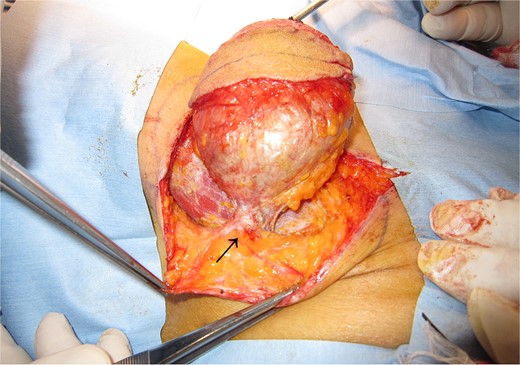 The mass was well-defined and easily removed. There was slight adhesion at core needle biopsy site (allow).