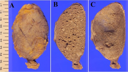 Formalin-fixed mass was covered with a thick white, fibrous capsule (Fig. 6A), which was filled gray substances like bean curd residue in cross section (Fig. 6B). The internal surface of capsule after removal of content was crepey, no nodule existed (Fig. 6C).