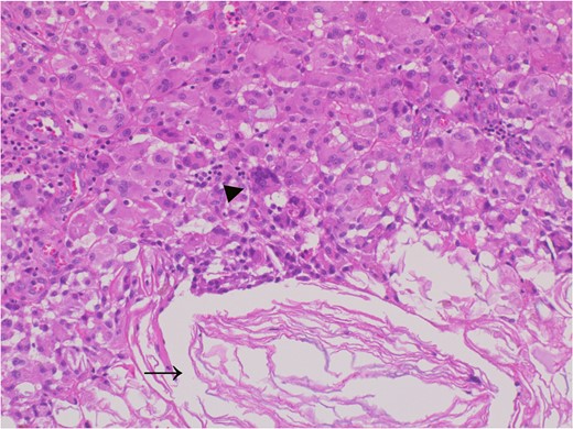 The adhesive region revealed keratin (allow) which flowed outside the cyst and granulomatous response for keratin with multinucleated giant cells (allow head), Hematoxylin and eosin stain, ×20 magnification.