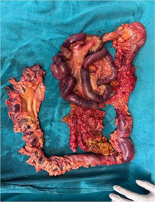 Resected intestinal segment
